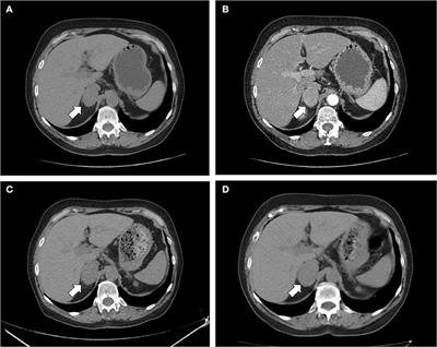 Tako-tsubo Syndrome as First Manifestation in a Case of Pheochromocytoma Developed From a Non-functional Adrenal Incidentaloma